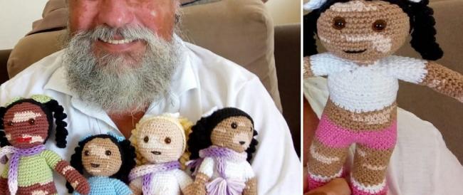 Vitiligine, il nonno che crea all’uncinetto le bambole con la stessa malattia per aumentare l’autostima dei bambini