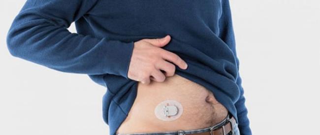 Un cerotto digitale contro il diabete che monitora la glicemia: l'ultima innovazione di Menarini