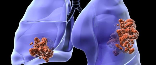 Il tumore al polmone resta ancora una neoplasia molto frequente.
