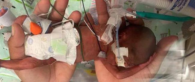 Nasce a 21 settimane e un giorno: è il bimbo più prematuro al mondo