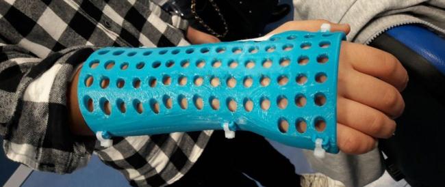 Braccio fratturato, addio al gesso.